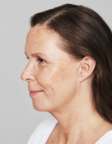 Restylane® SKINBOOSTERS™-before