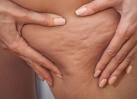 Cellulite