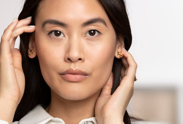 Acne scars & removal