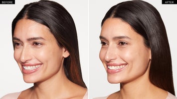 Before and after with a Sculptra treatment