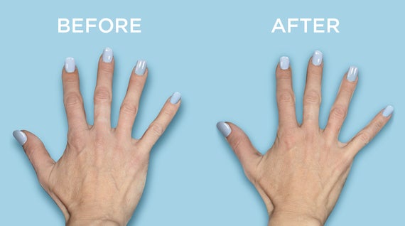 Hands before and after treatment with Restylane