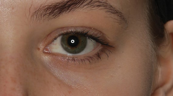 THE MAIN CAUSES OF SHADOWS AND DARK CIRCLES UNDER THE EYES