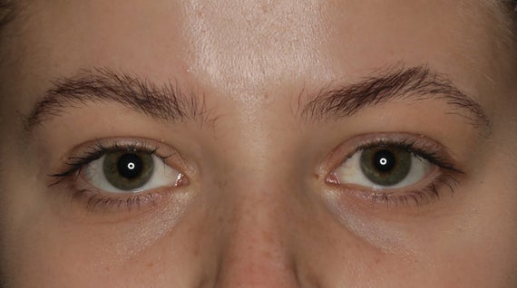 THE MAIN CAUSES OF SHADOWS AND DARK CIRCLES UNDER THE EYES