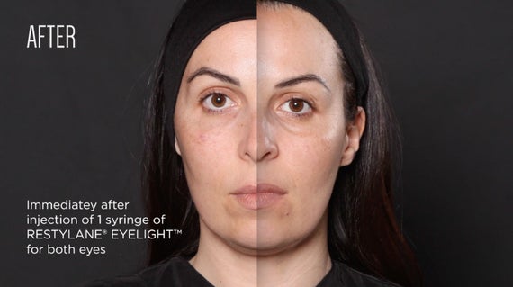 Eyelight Before and After