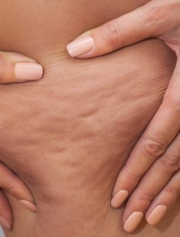 Cellulite