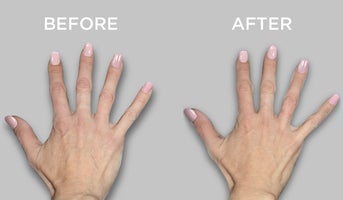 Galderma aesthetics and Restylane - Hydrate from within - Restylane skin boosters for the hands