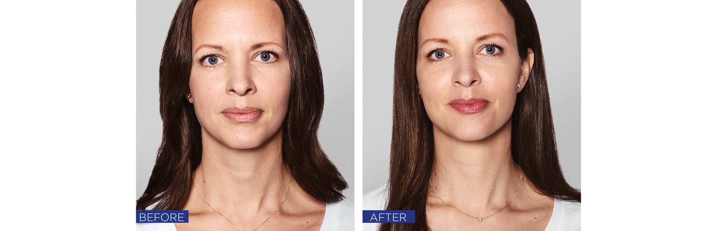 Before and after treatment with Restylane® Skinboosters™