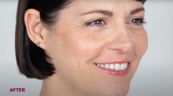 Cara's Sculptra Story