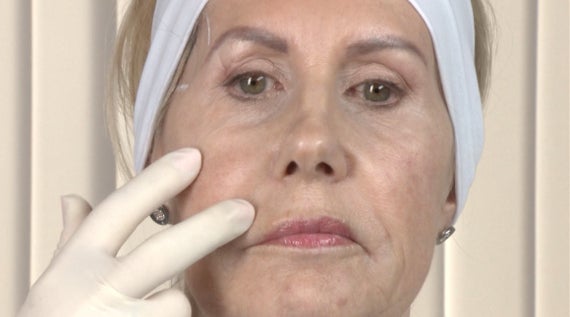 LOSS OF FACIAL FAT.